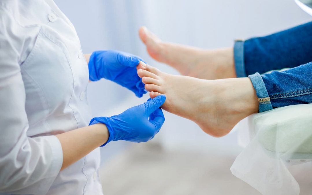 Comment soigner une mycose de l’ongle du pied ?